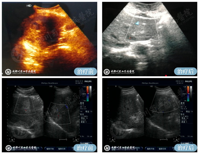 【成都血管瘤治疗案例】智能腔内综合治疗前后对比10